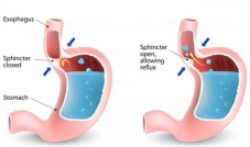 Acid reflux disease